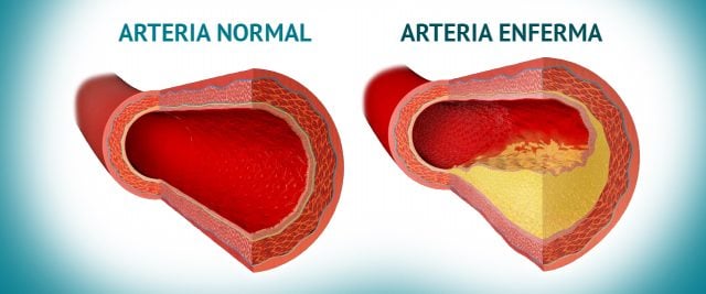 arterias